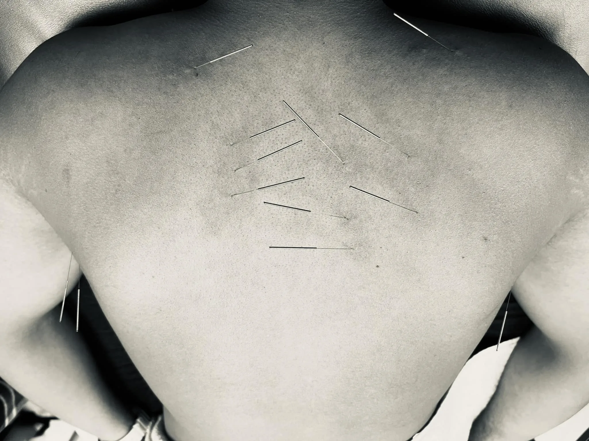 Dry needling treatment across the upper back