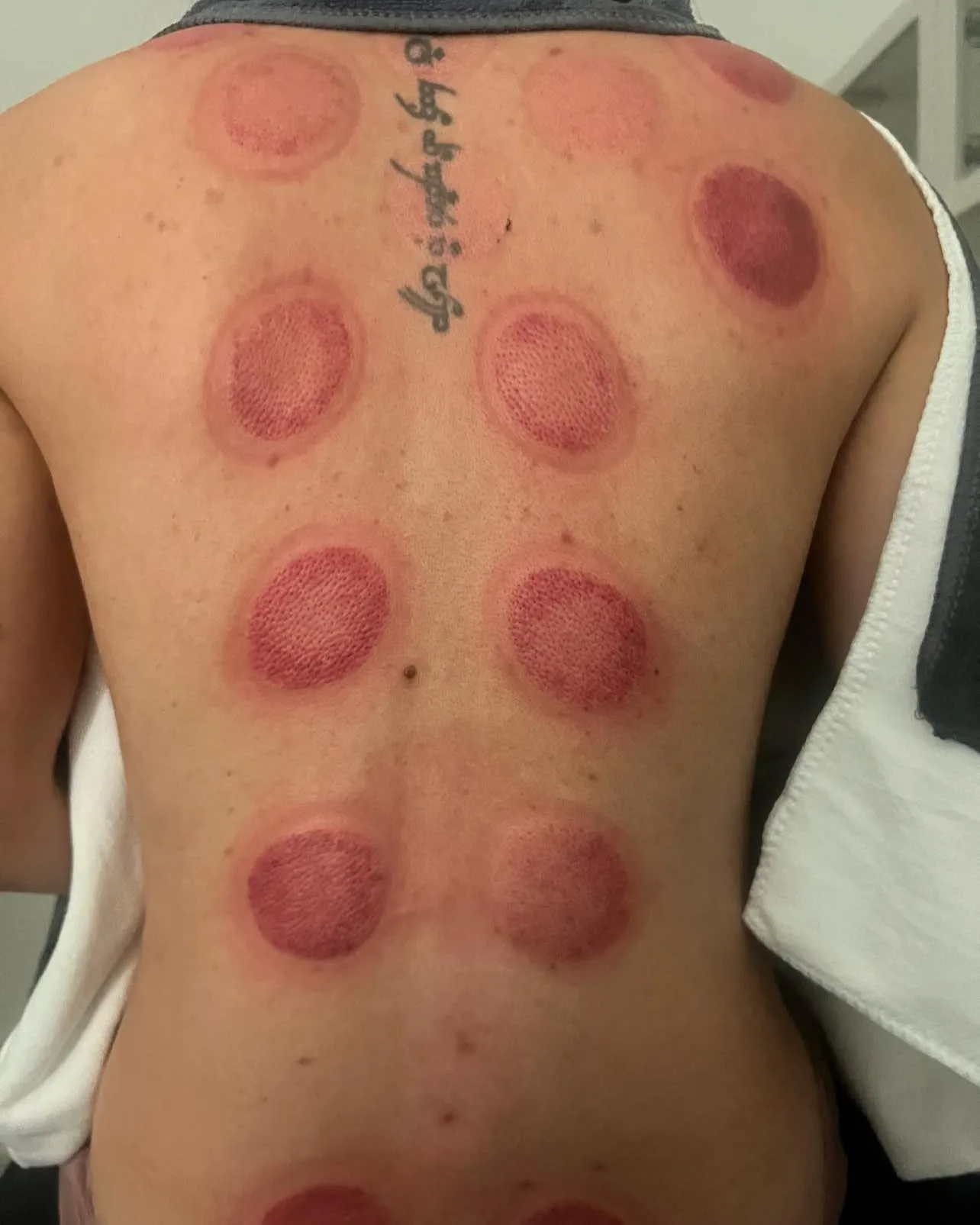 Flame cupping marks along the back after treatment